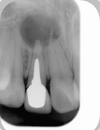 前歯にできた歯根嚢胞