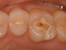 奥歯のコンポジットレジンが対合歯により 摩耗した症例