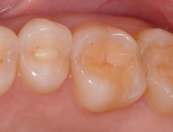 図3の歯をセラミックで修復して6年経過後