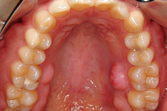 上顎大臼歯部舌側にできた骨隆起