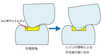 コンポジットレジンが摩耗すると 対合歯が移動して食い込んでくる