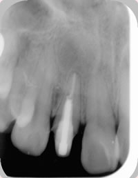 1年後のレントゲン写真