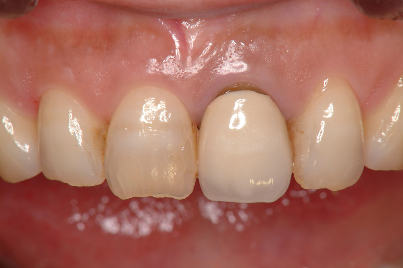 治療前.被せ物の根元の変色が気になる．歯の変色で歯肉も暗く見える