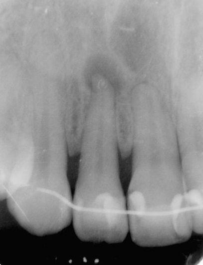 図1a 上顎側切歯の根尖病変. 根尖部にレントゲン透過像(黒い影)が見られる