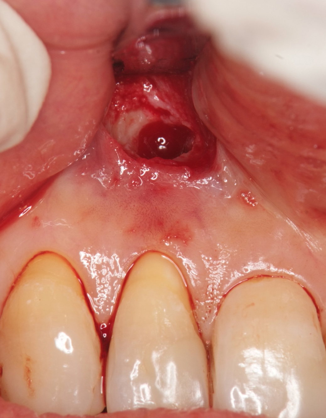 図1b 根管治療後1年経過しても病変の縮小がなく、歯根端切除と嚢胞摘出を行った