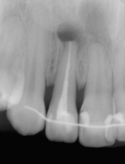 図1c 歯根端切除および嚢胞摘出後のレントゲン写真