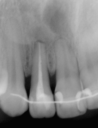 図1d 1年後病変が消失し治癒した