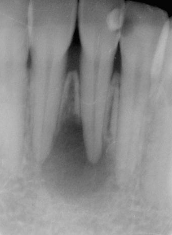 図2a 下顎中切歯の根尖病変.かなり大きいレントゲン透過像