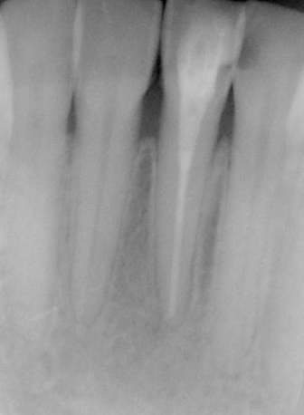 図2b 根管治療のみで1年後に病変が消失し治癒した